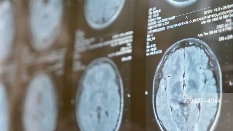 Nový zázračný lék na smrtící nádory mozku? Vědci s úspěchem vyzkoušeli nosní kapky